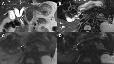 The Evaluation of Zoomed Echo-Planar Diffusion-Weighted Magnetic Resonance Imaging With Two-dimensional Spatial-Selective Radiofrequency Excitation Pulses in Patients With Hilar Cholangiocarcinoma